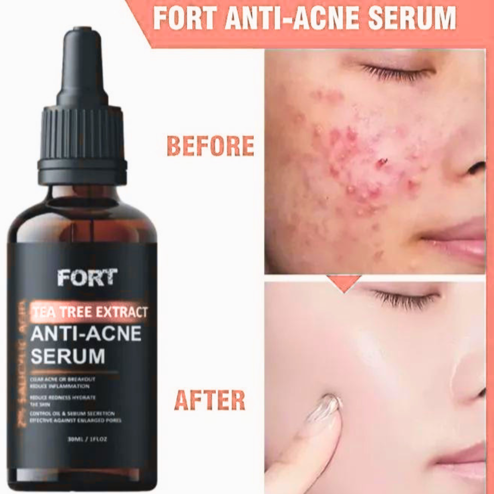 Anti Acne Face Serum for Clear & Glowing Skin – Oil Control Tea Tree Serum 30ml