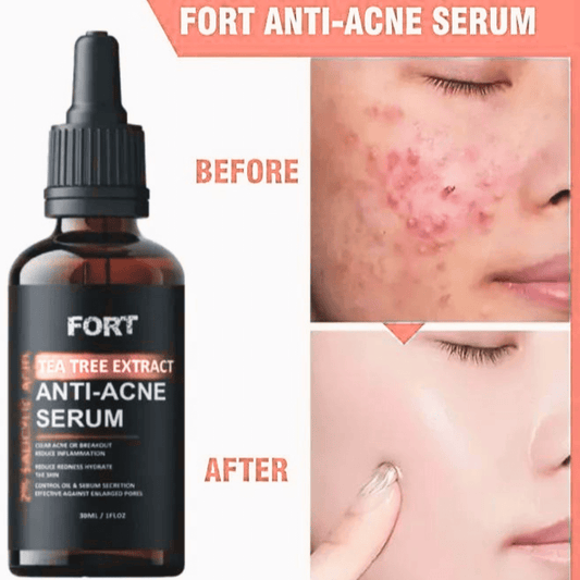 Anti Acne Face Serum for Clear & Glowing Skin – Oil Control Tea Tree Serum 30ml - Deal Gloss